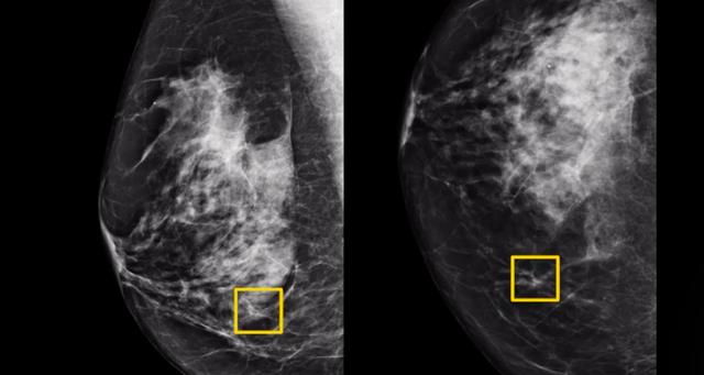 谷歌AI检测乳腺癌准确率超人类医生-第1张图片-IT新视野